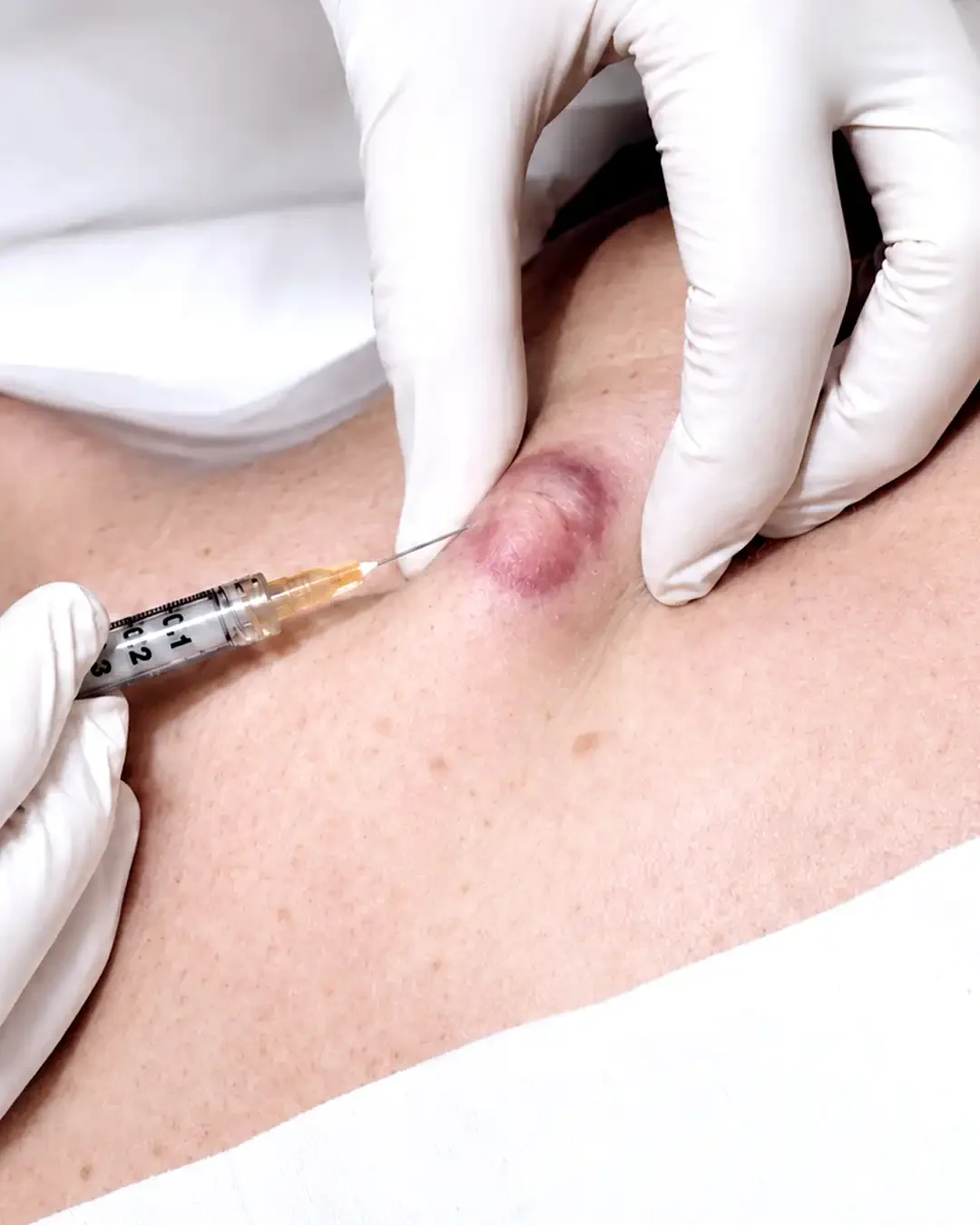 瘢痕疙瘩处理（Keloid Removal）
